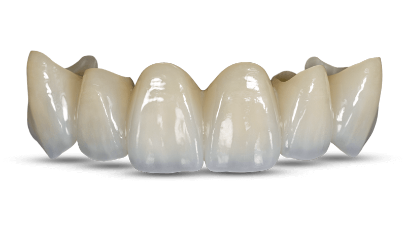 High-translucent zirconia bridge