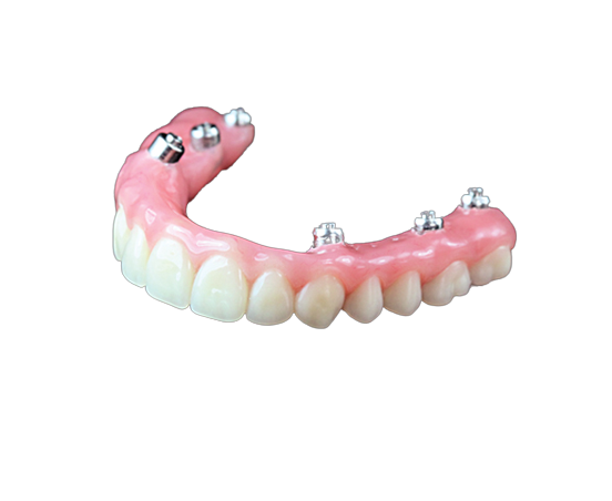 Hybrid Dentures