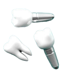 Dental Implants