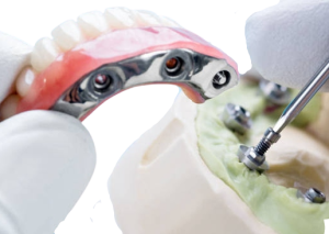 Hybrid Dentures