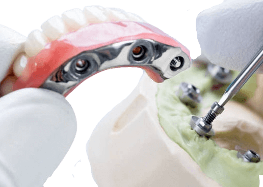 Hybrid Dentures