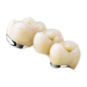 3-unit PFM dental bridge restoration with metal collar
