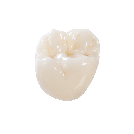 Porcelain Fused to Zirconia Dental Crown