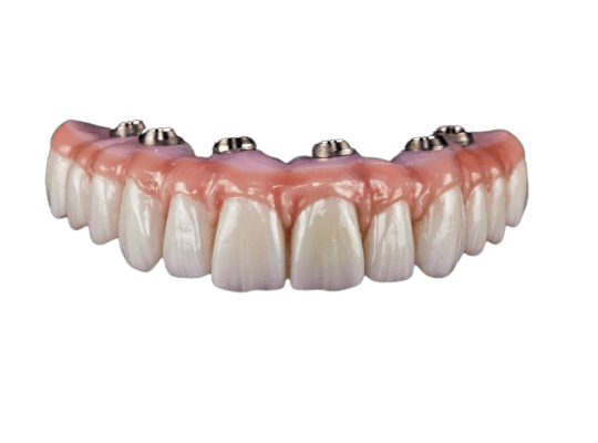 Implant retained zirconia prosthesis denture all-on-6