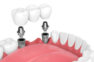 Dental Implants: How To Explain Them To Your Patients