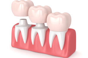 Is A Dental Crown Necessary With A Root Canal Procedure?