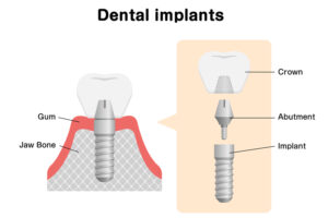 Is Your Patient A Candidate For Mini Dental Implants?