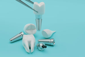 Understanding The Process Of A Custom Zirconia Implant In A Dental Lab