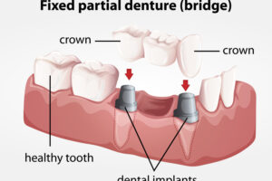 What You Need To Know When Choosing Zirconia For A Dental Bridge