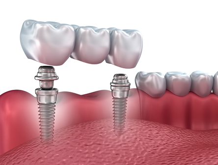 Are Hybrid Dental Implants A Permanent Solution For Your Patients?