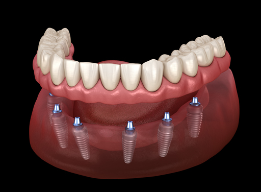 Hybrid Denture Vs. All-On-4: Key Points For Dentists In Treatment Planning