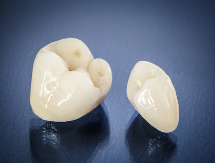 Zirconia Crown Vs. Porcelain: Which Is Best For Your Patients' Needs?