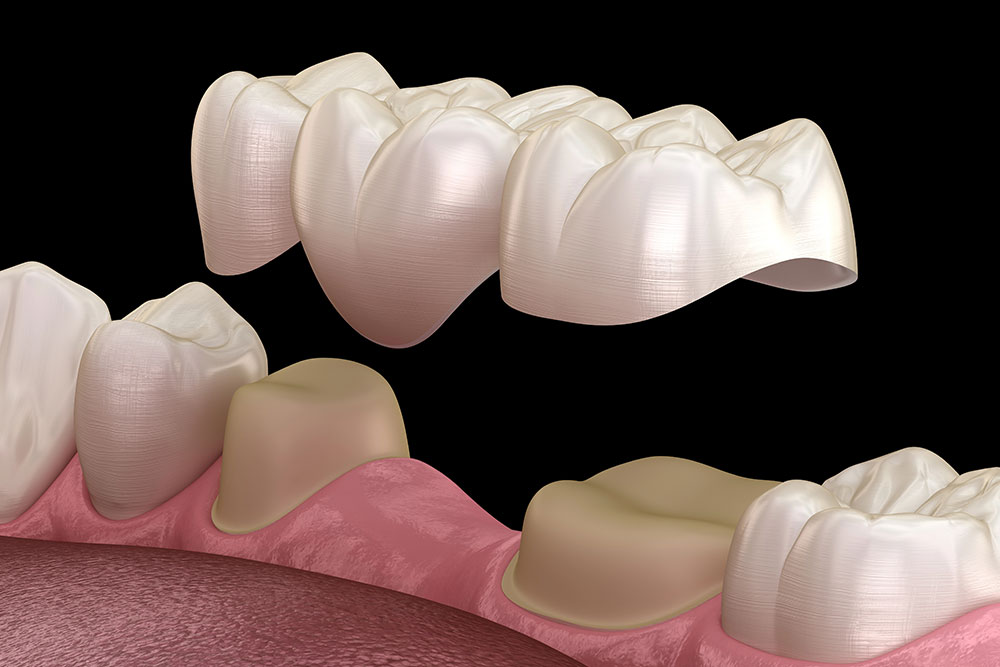 best-practices-for-zirconia-crown-cementation