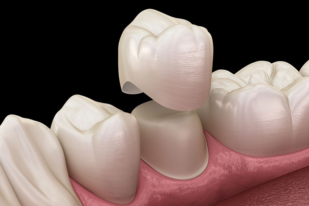best-practices-for-zirconia-crown-preparation