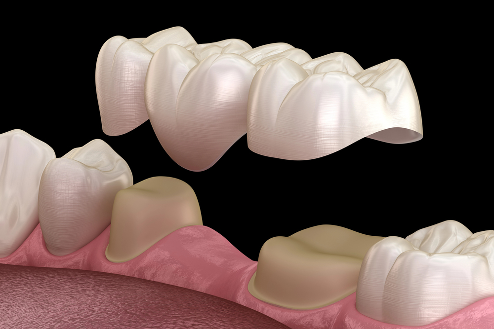 new-dental-bridge-technology-enhancing
