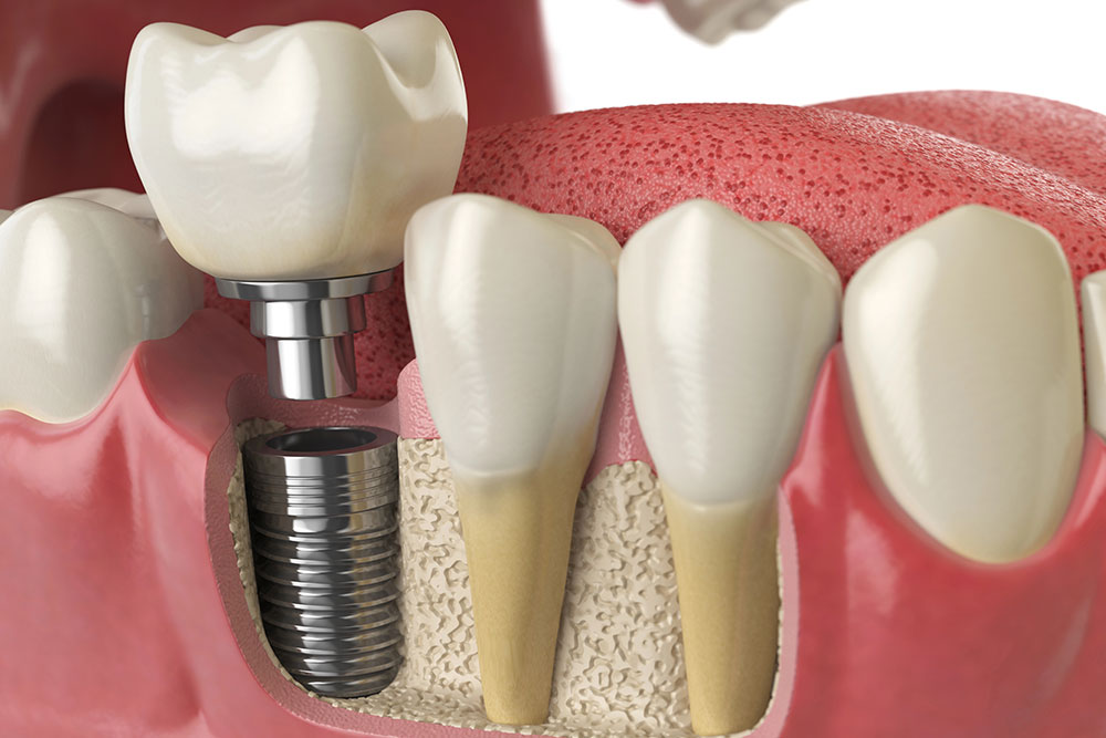 Which Cement Works Best For Implant Crowns?