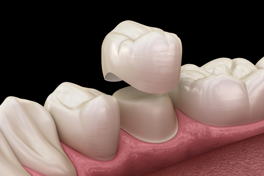 Dental Crown Vs. Filling: How Dentists Decide The Best Treatment