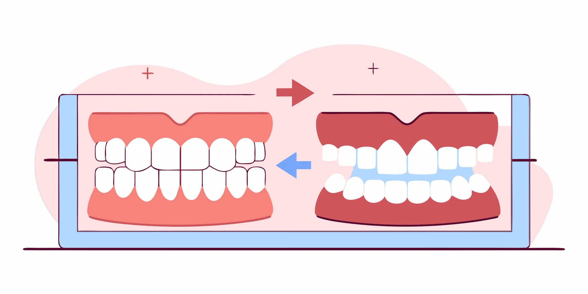 A flat design medical illustration of a complete denture setup showing proper denture occlusion and teeth alignment